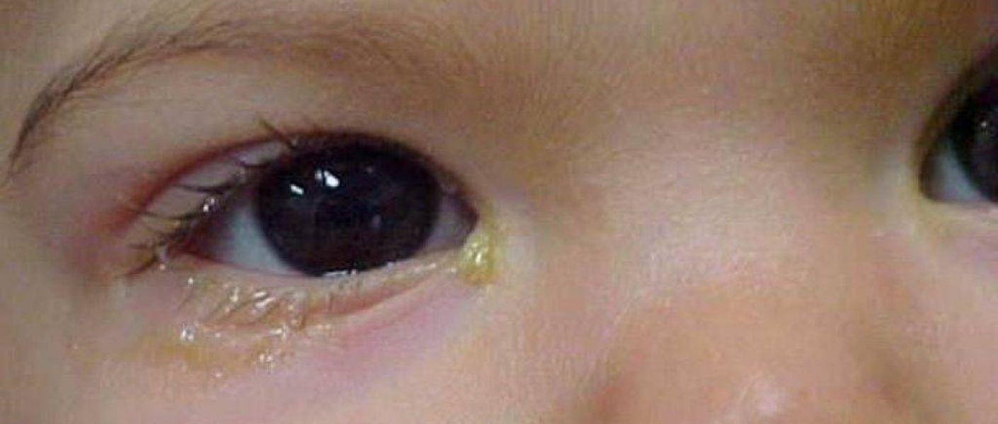 Чем вылечить глаза у ребенка