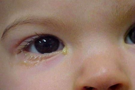 Чем вылечить глаза у ребенка