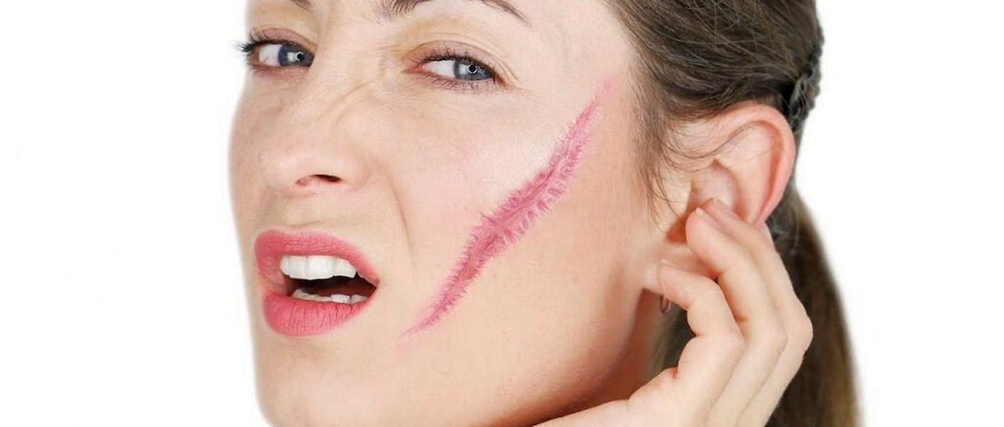Советы: как убрать шрамы на лице у девушек
